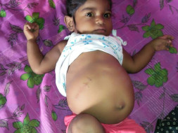1-year-old Keerthana with a bloated stomach fights liver failure
