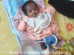 Help 2-Months Old Meethi Fight Intestinal Malrotation