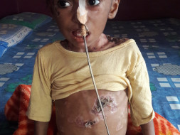 Help This 2-year-old Who Has A Disease That Is Eating Up Her Skin