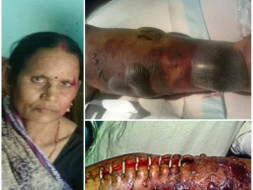 Help 55 -Year-Old Asha Devi Fight Against Necrotizing Fasciitis