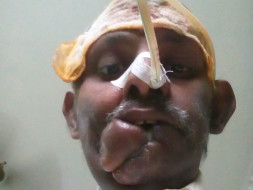 Help Venkat Fight Mouth Cancer