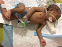 Reema's new born is on life support and fights to survive