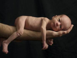 Help Preterm twin babies treatment to recover from extreme prematurity