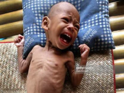 Help poor children to fight malnutrition
