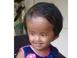 Help Little Reshmi Fight Hydrocephalus