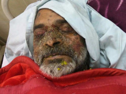 Help Mr Anil Kapil, who is in ICU, fight Sepsis and Bullous Pemphigoid