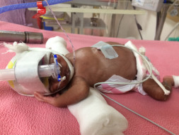 Help for my pre-mature baby
Born in 25th week