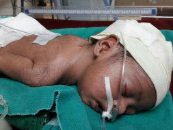 3-Month-Old Baby Needs An Urgent operation
