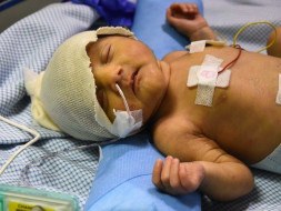 16 days old Baby of Saha needs an open heart surgery to survive.