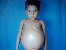 Help Joseph Raj From Gaucher Disease