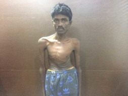 This 20-year-old Man Hasn't Slept For Years Because Of His Bent Spine