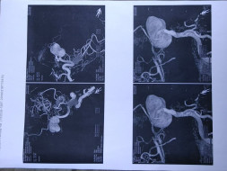 Need help for Brain hemorrhage patient
