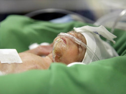 Only 6 Days Old, This Baby Is Not Strong Enough To Breathe On His Own