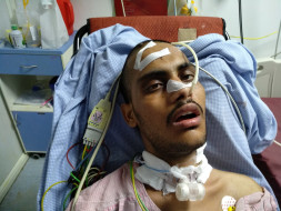 No One Knew That 22-Year-Old's Chronic Headaches Were From Brain Tumor