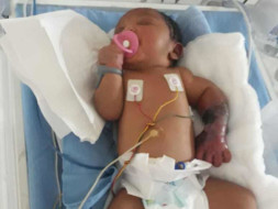 Help This New Born Whose Left Limb Is Infected By Gangrene Since Birth