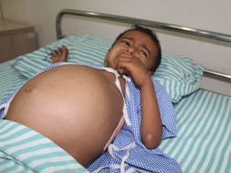 Baby's Stomach Has Swollen To The Size Of A Football Because Of Cancer