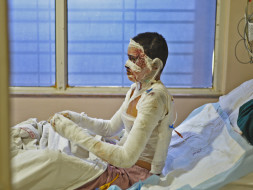 A Transformer Burst And Left This 24-Year-Old Completely Burnt
