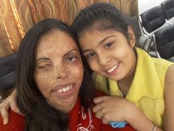 Help For Acid Attack Survivor And Her Family