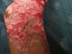 Help Nisha The Acid Victim