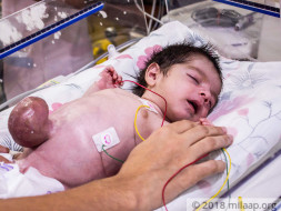 Baby Born With Intestine Outside His Body Has Only Few Hours Left