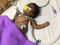 Help 3 Month Old Baby Angela For Heart Surgery
