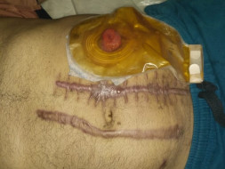 Pleading Help To Save Mr.gani Ailing From Cancer