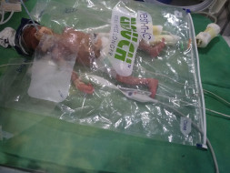 Help Prabhakar's son to come out of NICU