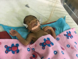 Help New Born Premature Baby to Survive