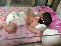 Help Pooja's New Born Baby went through Intestinal Obstruction Surgery
