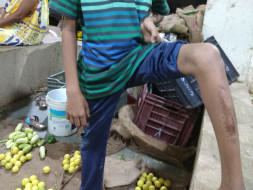 Help Prajwal Walk And Run