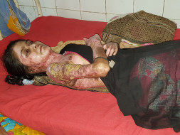 Help Juhi Who Had A Tragic Accident After the Gas Cylinder Burst.