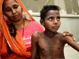 14-year-old with painful boils all over body needs urgent transplant