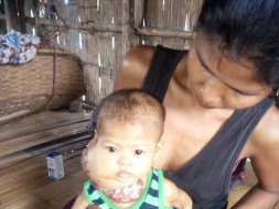 Help Baby Kaokuchangti Fight Against deadly Arteriovenous