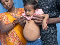 If Baby Lokesh does not get a new liver soon, he may not survive