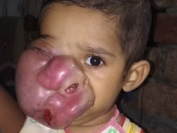Help Baby Rohan Fight Against Deadly Rhabdomyosarcoma