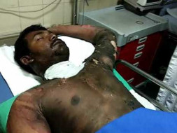 Help Satish Kumar Who Suffered 80℅ 3rd° Burns And Is Fighting For Life