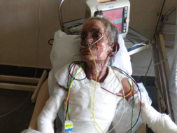 Mr & Mrs Mayekar Who Got Severly Burn Due To Gas Cylinder Leakage .