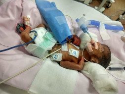 Please Save The Twin Babies
