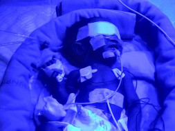 Help A Baby Undergo A Lung Surgery