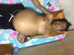 Help My Father Undergo Liver Transplant