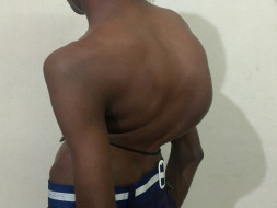 Help Shivakumar Recover from Spinal Cord Disorder