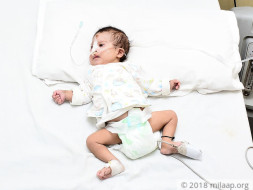 Baby Born With Down Syndrome Has A Serious Heart Defect, Needs Help