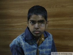 Prince lost his eye to cancer, need help for treatment