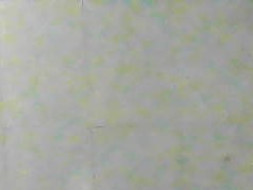 My mother had a bone crack and during operation her one vein got a cut