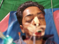 Help My Friend Recover from Temporal EDH with Femur Fracture