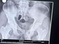 Help anil to survive from the accident