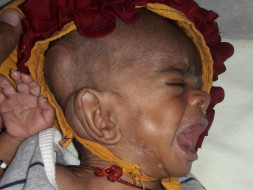 Help 4-month-old Baby Suffering From Hydrocephalus