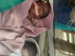 Help My Brother's Twin Babies Suffering LBW
