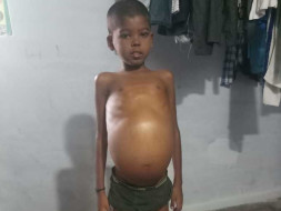 Help Little Arul Undergo Liver Transplant