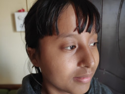 Help Junmoni For Her Nose Surgery